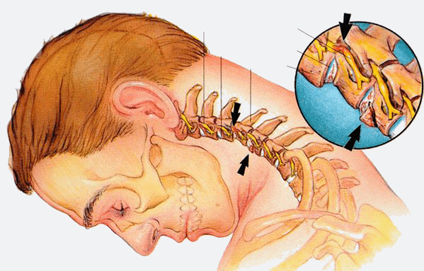 stages of osteochondrosis of the cervical column
